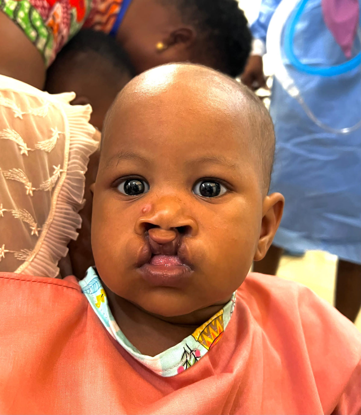 Fund Life-Changing Cleft Surgeries in Ghana with Operation Smile