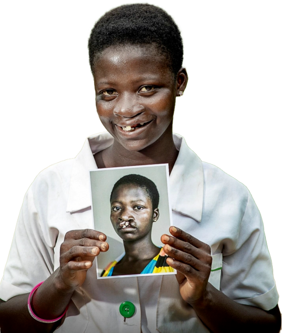 Fund Life-Changing Cleft Surgeries in Ghana with Operation Smile