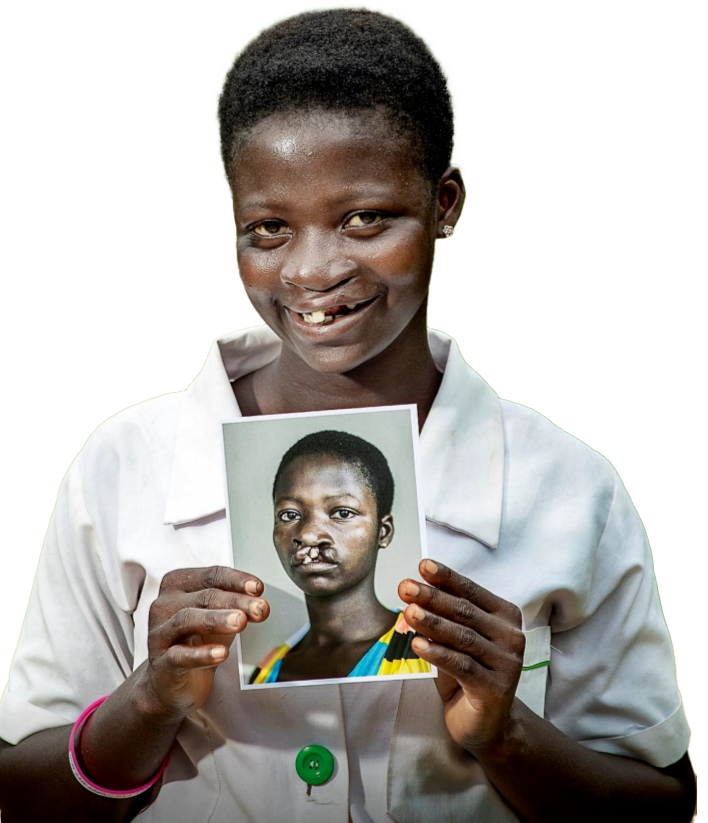 Fund Life-Changing Cleft Surgeries in Ghana with Operation Smile
